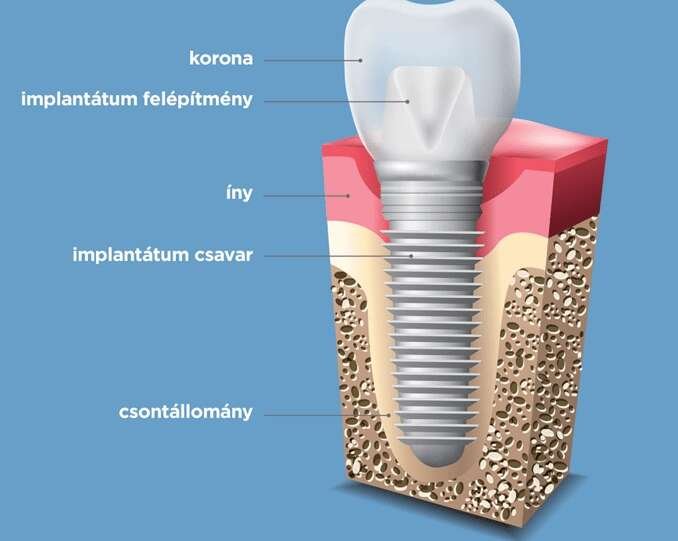 Teljes fogbeültetés és foghúzás altatással
